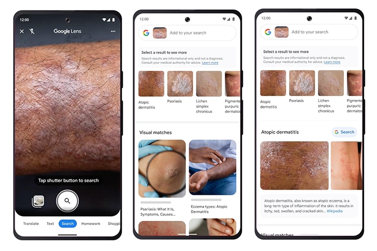 Google Lens Can Detect Skin Conditions